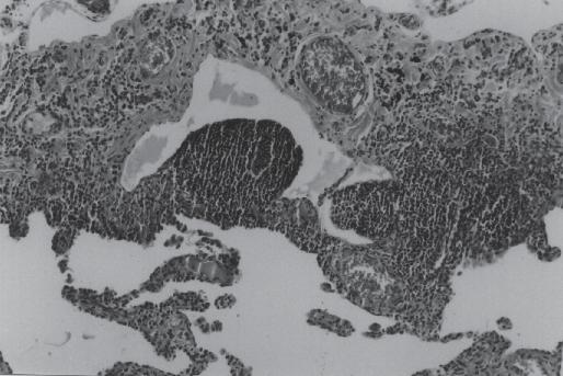 Coletta ENAM Figura 9 Pneumonia intersticial linfóide (PIL) agregado linfóide perivascular. HE (100x). mo bronquiolite folicular é usado (5,6).