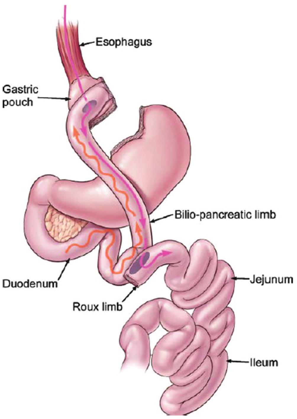 COMPLICAÇÕES CIRÚRGICAS PRECOCES APÓS BYPASS GÁSTRICO: REVISÃO DA LITERATURA abdominal, como o longo segmento de isquemia intestinal.