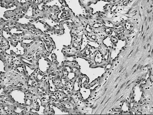 histopatológico. Nos cortes microscópicos corados por hematoxilina e eosina (HE) observou-se epitélio estratificado escamoso delgado e atrófico.