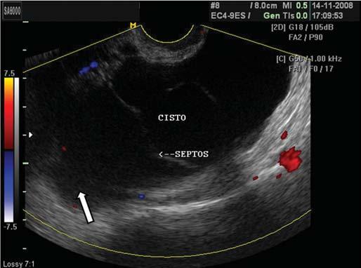 B: O uso do Doppler colorido, na mesma paciente, descarta vascularização no interior da massa (seta interrompida), ajudando na caracterização do coágulo. Figura 6. Cisto para-ovariano.