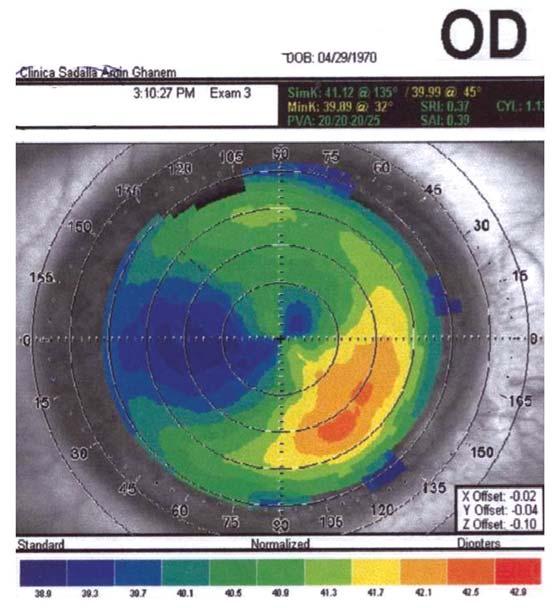 Foi submetida à cirurgia para a correção de miopia (-1,75 DE -0,25 DC x 5 ) do OD há 5 meses e queixava-se de visão borrada e cefaléia.