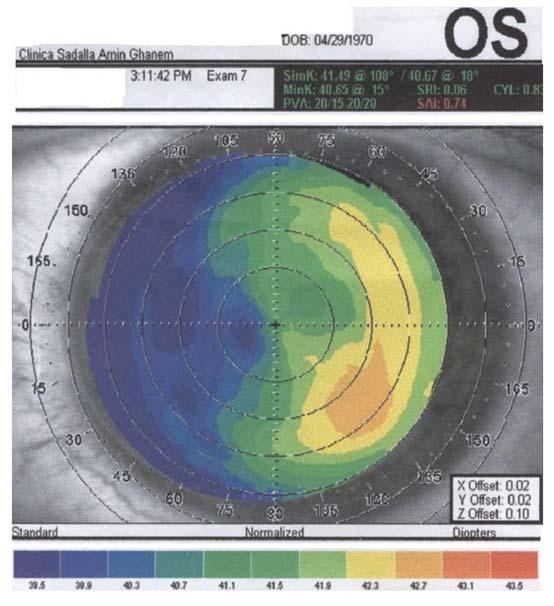 A topografia apresentava um astigmatismo irregular secundário a uma ablação descentralizada pós-lasik (Figura 7).