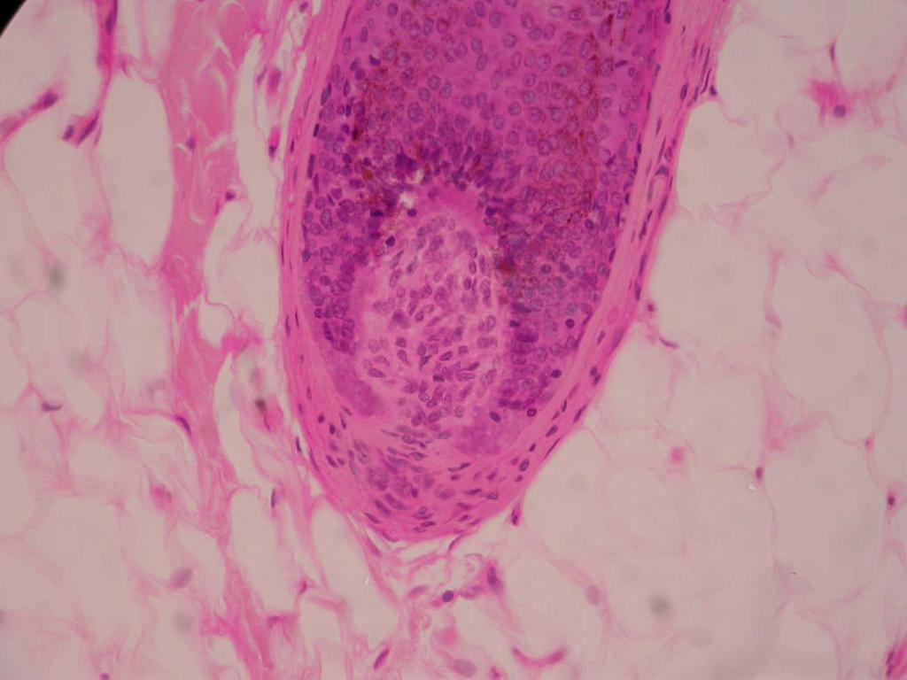 Observação com aumento total de 400x: Neste outro campo microscópico, com o mesmo aumento de 400x, podemos observar detalhe do bulbo piloso muito visível.