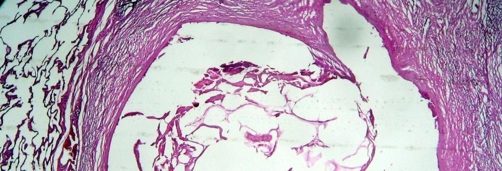 Figura 15, fotomicrografia 10: Lesão no parênquima