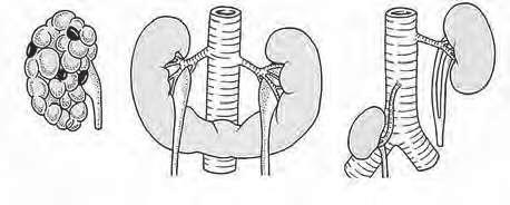 UROLOGIA FUNDAMENTAL Fusão renal: rim em ferradura é a forma mais comum de fusão renal (Figura 4). É a fusão na linha média de duas massas metanéfricas distintas, cada qual com sua pelve e seu ureter.