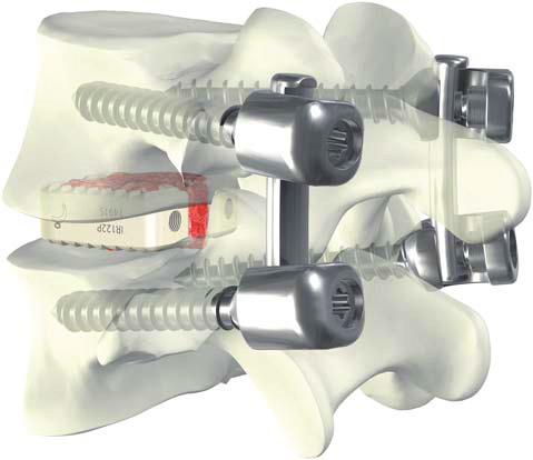 O EASYSPINE ABRANGE TODAS AS PATOLOGIAS Easyspine e fusão dinâmica Hastes finas melhoram a carga do enxerto 600 500 400 300 200 100 0 583