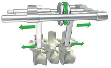 O EASYSPINE ABRANGE TODAS AS PATOLOGIAS Easyspine e