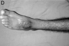 Procedia-se então à isquemia do membro e iniciava-se a dissecção do retalho. O retalho foi marcado na região posterior da perna com o maior eixo no sentido longitudinal mediano (Figura1).