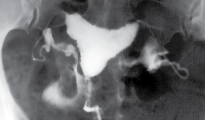 Fi g u r a 30 - C.S.N. 27 anos. Abortamento espontâneo, seguido de curetagem uterina. Imagem da cavidade uterina normal.