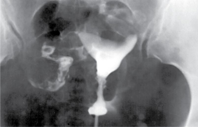 CONTROLE DE TRATAMENTO Figura 37 - Z.B.S. 31 anos. 1 para natural. Útero com morfologia normal.