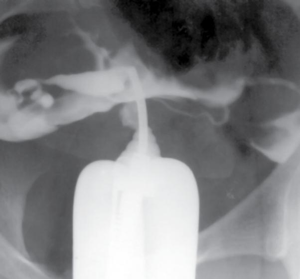 Trompas deixando-se injetar pelo contraste com ampla difusão do mesmo na cavidade peritoneal. Conclusão: Histerosalpingograma normal.