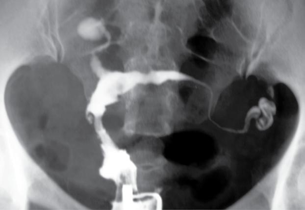 Adenomiose confirmada pós-cirurgia. Histerectomia total. Fi g u r a 75 - R. G. H. 58 anos. Para 6 naturais.