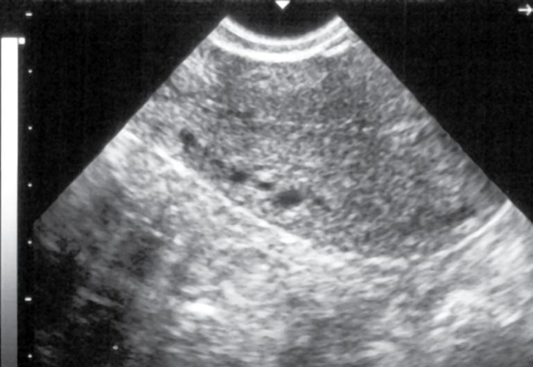 Gestação tópica 5 semanas (há 1 ano e 7 meses) seguida de abortamento espontâneo. Restos ovulares.