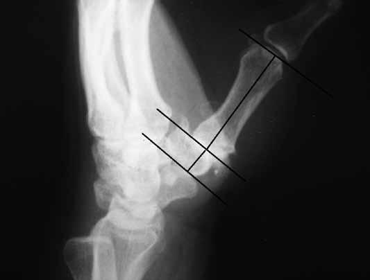 Os pacientes apresentados neste estudo configuram a população tipicamente acometida pela osteoartrose primária da articulação trapeziometacarpal, no que se refere à idade, sexo, cor e profissão,