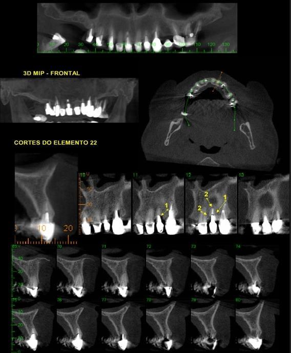 lesão perirradicular no dente 46. Figura 3.