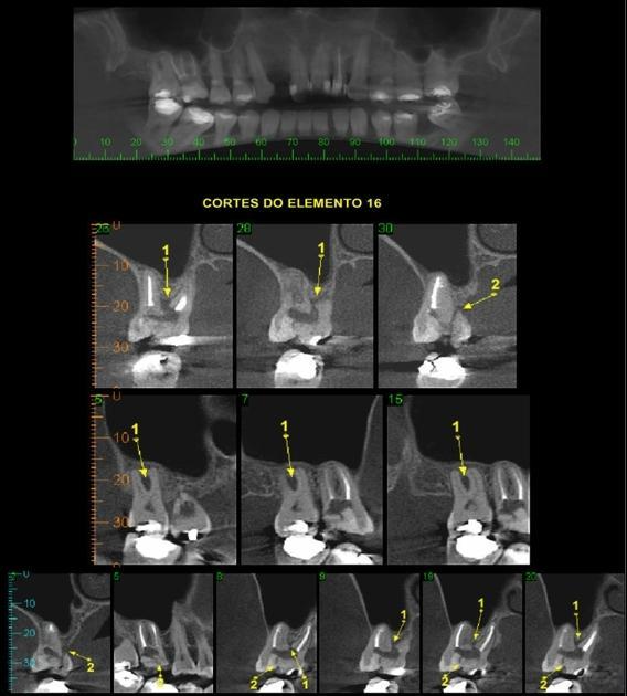 perirradicular e núcleo intraradicular no dente 26. Figura 7.