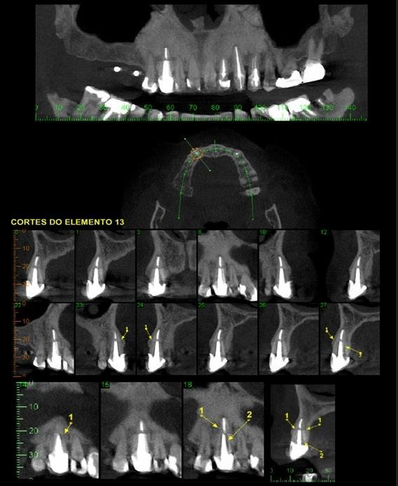 perirradicular, fratura radicular e lesão em furca no dente 26.