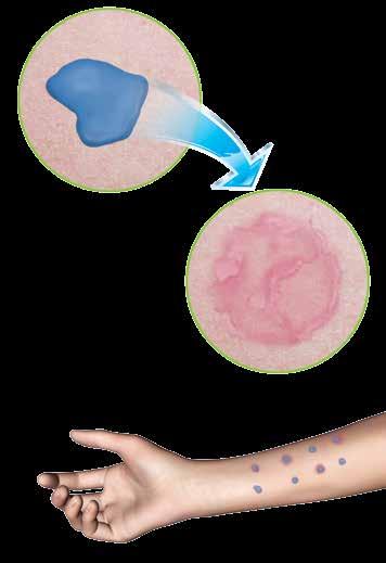 Teste cutâneo de hipersensibilidade 1,2,4,17 Coloca-se solução com
