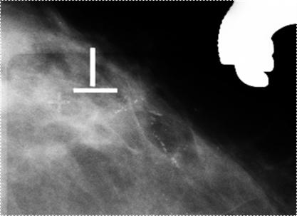 Imagens mamográficas obtidas sem (A) e após compressão (B) revelam microcalcificações finas, com morfologia variada, pleomórfica.