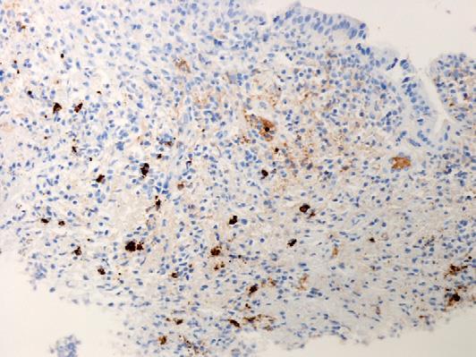 Biopsia de ducto biliar com imunohistoquimica