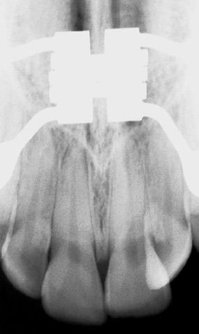 Avaliação da neoformação óssea na sutura palatina mediana por meio de radiografia digitalizada após a expansão assistida cirurgicamente
