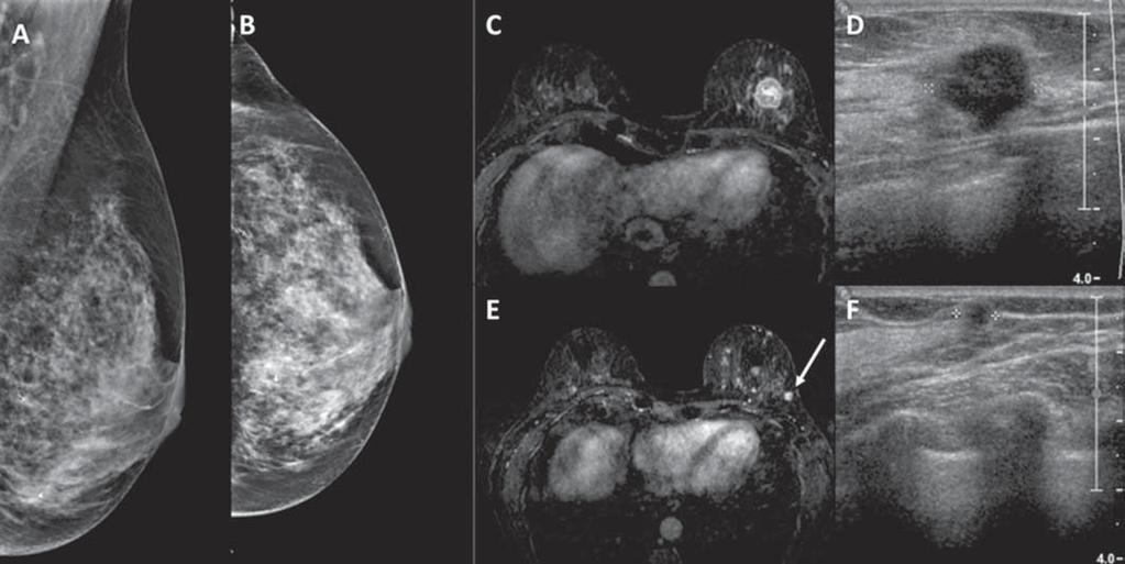 Figura 2. Paciente com mamas densas na mamografia (A,B). Ressonância magnética e ultrassonografia (C,D) mostram o tumor principal na mama esquerda como nódulo irregular.