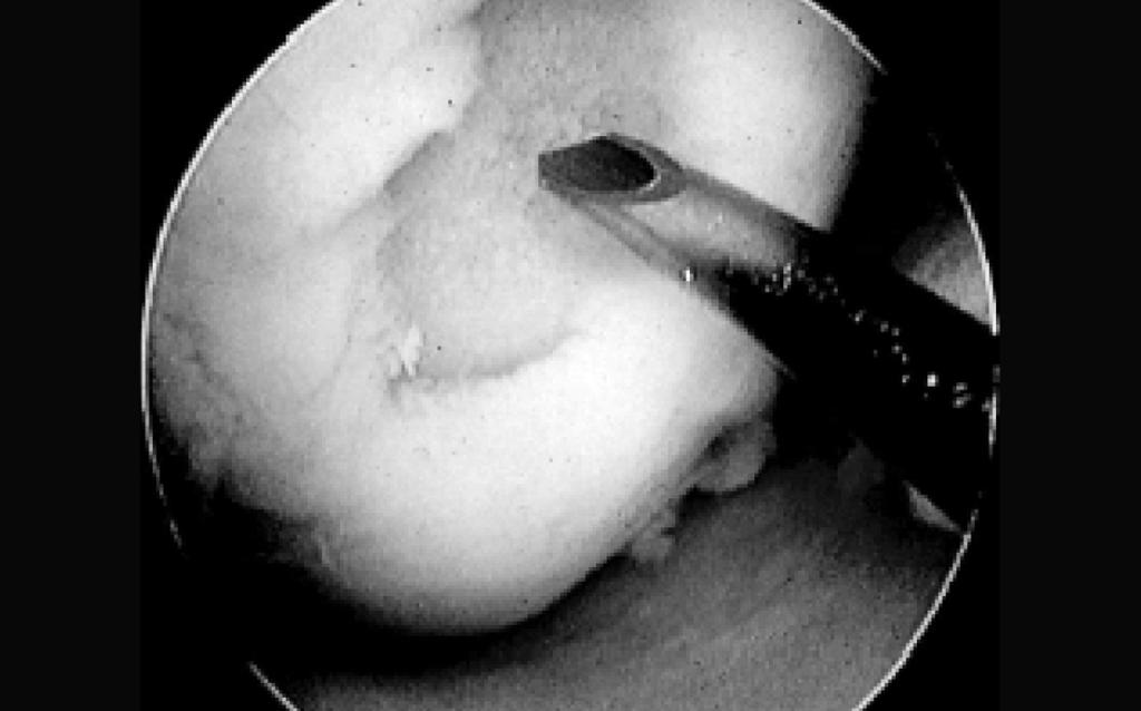 (1,8) mínimo máximo 1 8 Tempo pós-operatório (anos) média (dp) 2,3 (1,5) mínimo máximo 0,3 6,0 Cilindros osteocondrais Lesão osteocondral Figura 2 Mosaicoplastia A técnica pode ser feita por via