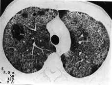 TCAR com aspecto semelhante aos casos anteriores, com padrão de pavimentação em mosaico disseminado pelos pulmões, preservando pequenas áreas de parênquima pulmonar.