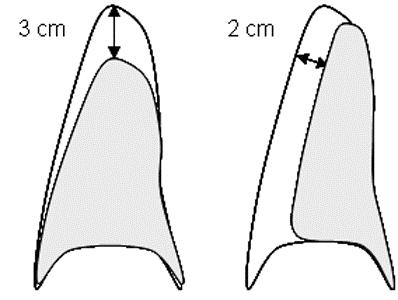 1. Observação Clínica Observação PODE SER o tratamento de escolha para PTX de PEQUENO VOLUME em Pacientes Estáveis [ Grau B ] Pacientes com PTX Espontâneo Primário pequeno (< 2 cm) e estáveis podem