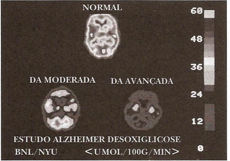 Imagens PET do cérebro de uma pessoa idosa saudável e de pacientes sofrendo da doença de Alzheimer.