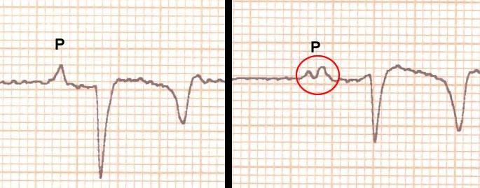 A onda P bífida (em formato de V) é descrita como uma variação fisiológica, que tende a se tornar menos frequente em animais submetidos ao exercício, devido ao aumento da FC [5].