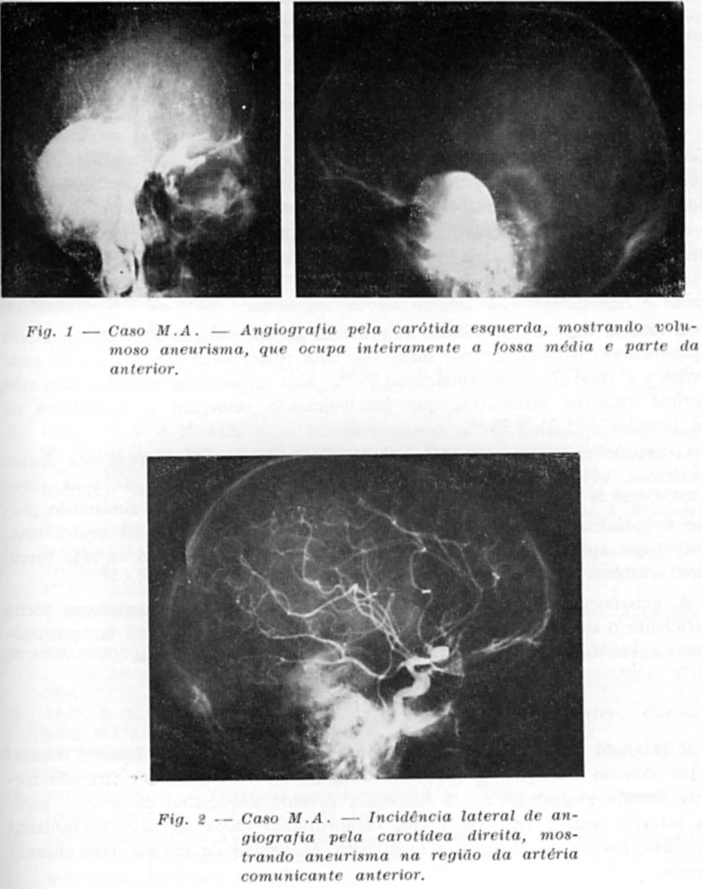 pirâmide esquerda. Eletromiografia dos músculos masseter e temporal esquerdos: degeneração total das fibras.