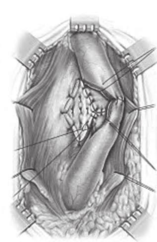 Reconstrução Urogenital Figura 10 Uretroplastia estentida. Figura 11 Manobras de aproximação dos cotos.