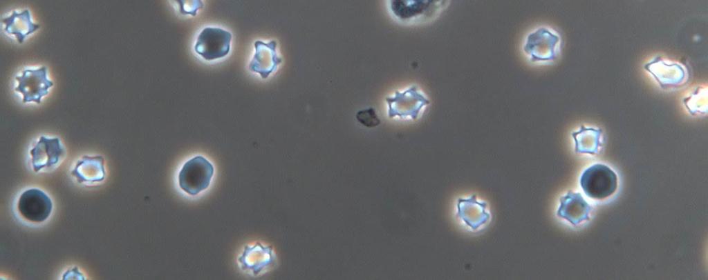 urina: normais (um marcador de hematúria não glomerular) e dismórficos (um marcador de hematúria