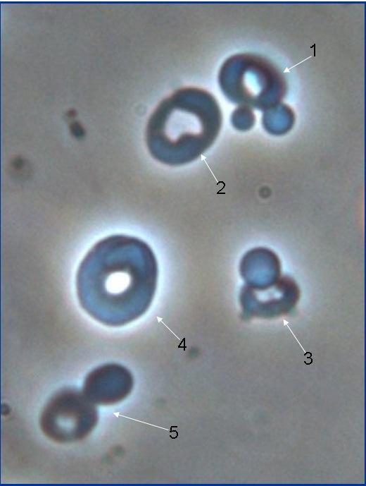 Questão 8 Na imagem ao lado vemos 5 eritrócitos com formato irregular (dismórficos). Destes quais são acantócitos? 1. 1,2,3,4,5; 2. 2,4; 3. 1,3,5; 4. 1,2,5.