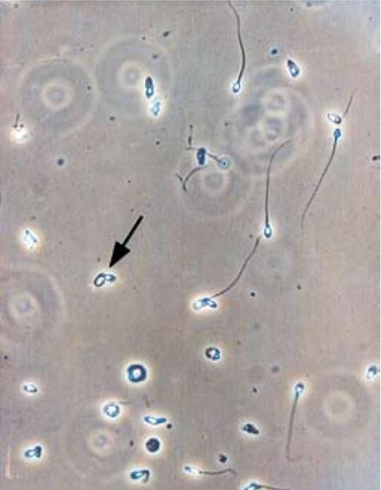 Questão 12 O tempo entre a coleta da amostra de urina e a análise microscópica do sedimento é crucial para uma identificação confiável dos eritrócitos dismórficos.