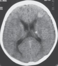 Realizou TAC cerebral que revelou lesões compatíveis com ET e ressonância magnética cerebral que mostrou a existência de nódulos subependimários e duas lesões nos buracos de Monro sugerindo