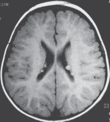 O electroencefalograma apresentava actividade paroxística frontotemporal bilateral, com predomínio frontal direito em vígilia e com electroestimulação intermitente.