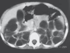 Susana Nunes, Maria Sameiro Faria, Conceição Mota, Íris Maia, Helena Silva, Maria José Jordão, Teresa Costa, Elói Pereira Figura 4: TAC abdominal apresenta rins de grandes dimensões e múltiplos