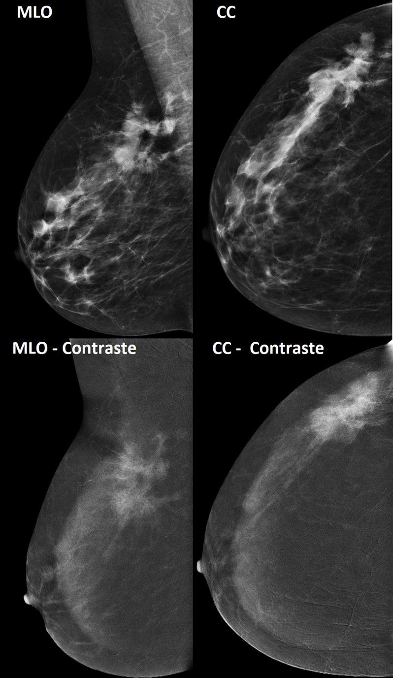 Fig 5 - Extensão local da lesão. Mama esquerda em incidências médio-lateral oblíqua (MLO) e crânio-caudal (CC) antes e após contraste. Doente de 55 anos, carcinoma ductal invasivo.