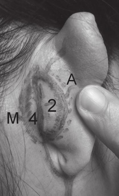 Pull-Through Subcutaneous Flap for an Anterior Auricular Defect. Dermatol Surg 2010;36:945-9. 3. Masson J.