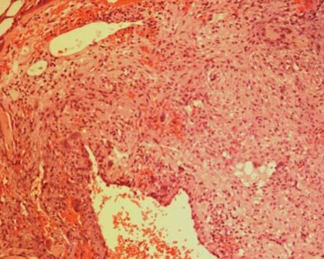 Pedro Amaral et al No exame anátomo-patológico realizado aos fragmentos da lesão, obtidos por curetagem, identificou-se uma proliferação fibroblástica de células mononucleadas, fusiforme ou ovoides,