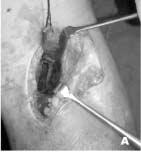 TÉCNICA CIRÚRGICA Com o paciente anestesiado, posicionado em decúbito dorsal horizontal, realizava-se a abordagem do joelho por incisão mediana anterior de aproximadamente 15cm, seguida de artrotomia