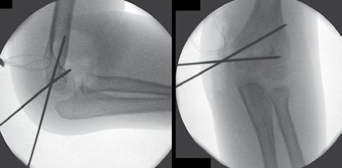 Radiologicamente, observou-se uma fratura do côndilo medial do úmero, com desvio e sem luxação do cotovelo, Kilfoyle tipo III (Figura 2).