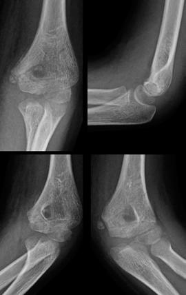 Manteve uma imobilização gessada braqui-palmar, que foi retirada às 5 semanas de pós-operatório conjuntamente com os fios de Kirschner (Figura 4). Figura 3. Radioscopia peri-operatória.
