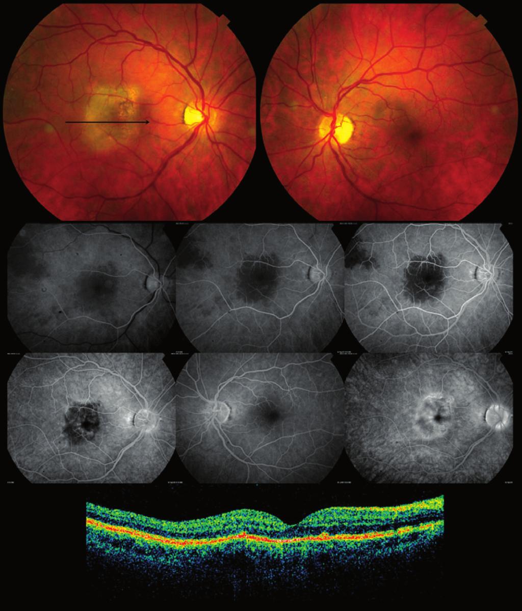 Coroidite serpiginosa macular: relato de caso 725 A B C D E F G H I Figura 1 - Aspecto da lesão ativa de coroidite serpiginosa macular do olho direito observada pela retinografia (A), angiografia