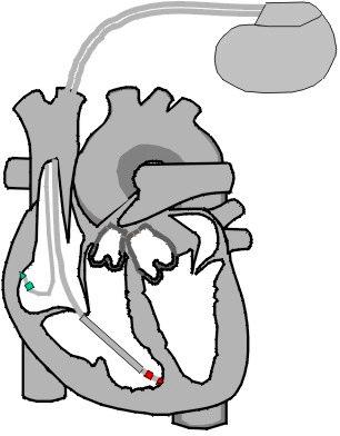 22 para cardioversão ou desfibrilação na região da ponta do ventrículo direito.