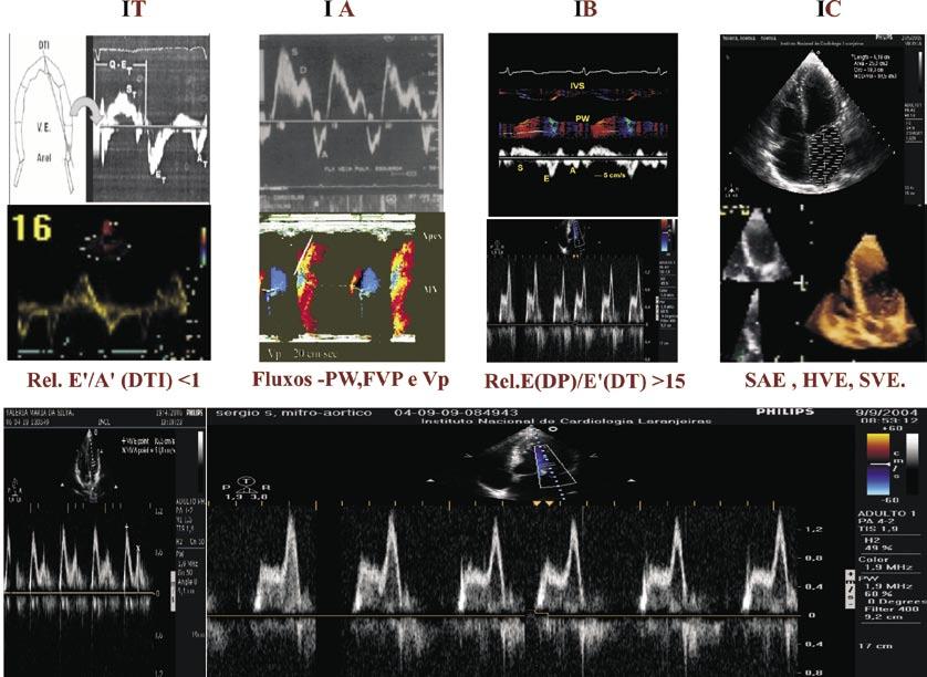 Discussão Neste artigo, demonstra-se que a disfunção diastólica do VE tipo I estava associada a diferentes significados, conforme o grupo de indivíduos avaliado.