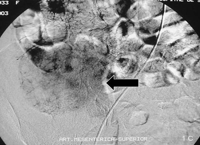 A embolização terminou quando se verificou, na arteriografia de controlo, uma redução bastante significativa, quase inexistente, da circulação patológica (Fig. 2). Fig.