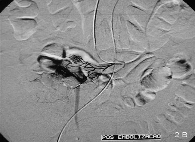 a) Artéria cólica direita (ACD), artéria ileo-cólica (AIC) e artéria ileal distal (AID); b) Fase arterial precoce: formação nodular hipervascular com aproximadamente 10cm (seta) no território da